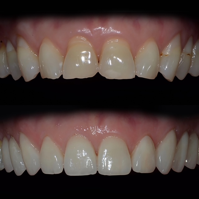 Porcelain Before & After